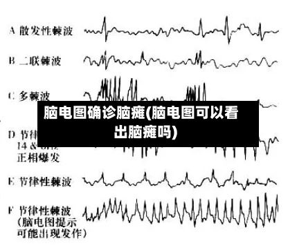 脑电图确诊脑瘫(脑电图可以看出脑瘫吗)-第3张图片