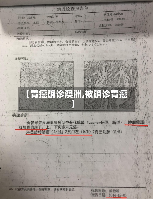 【胃癌确诊澳洲,被确诊胃癌】